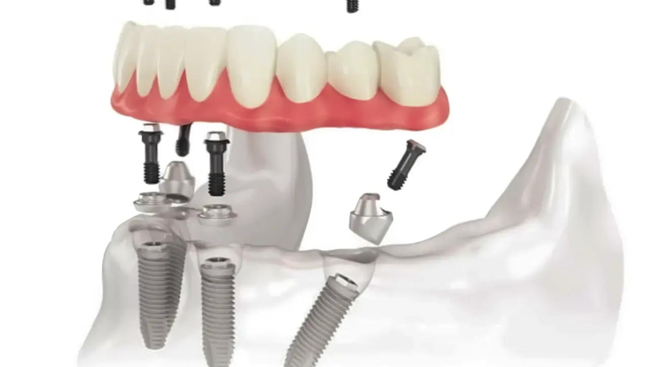 Zubni mostovi primjer