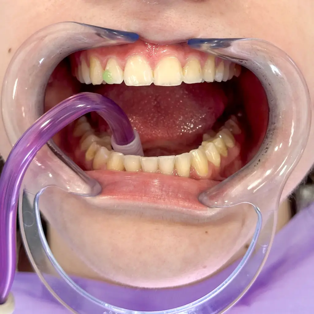 Zubni nakit postupak ugradnje nakita.