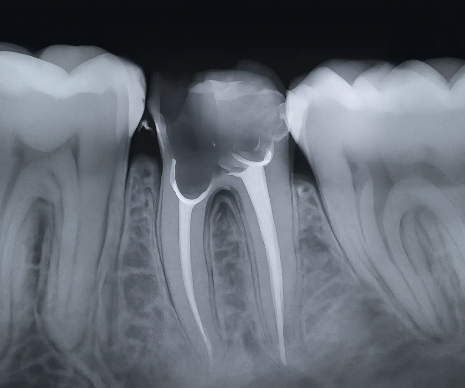 Snimka jednog zuba i korjena